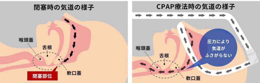 CPAP療法｜盛岡市でいびき外来なら、ちば耳鼻咽喉科クリニック