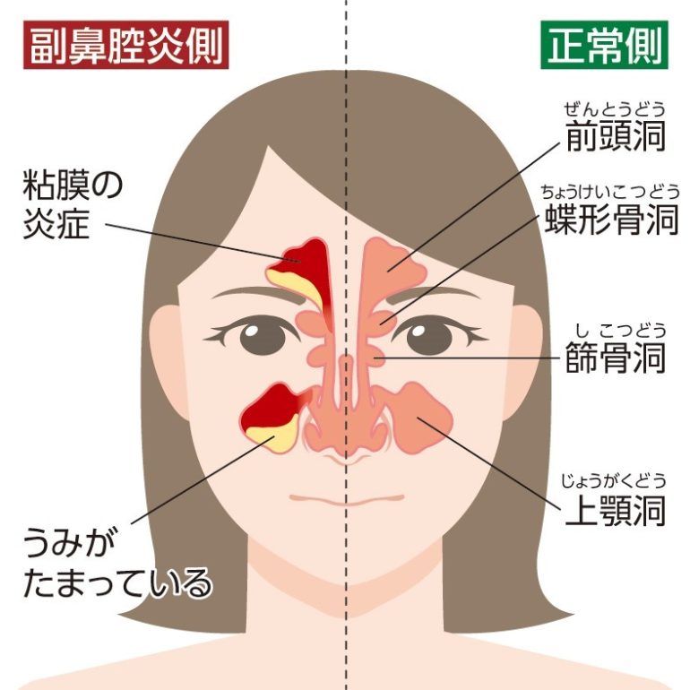 副 鼻腔 炎 血 が 混じっ た 鼻水